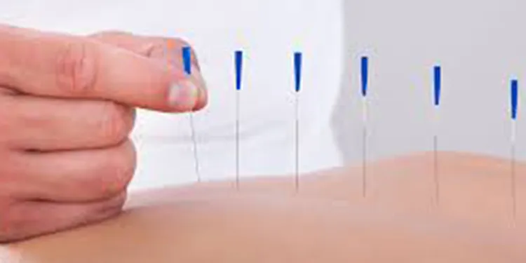 Dry Needling