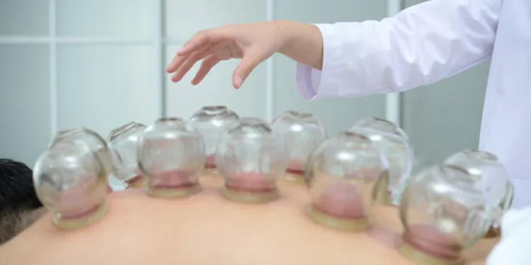 Cupping therapy